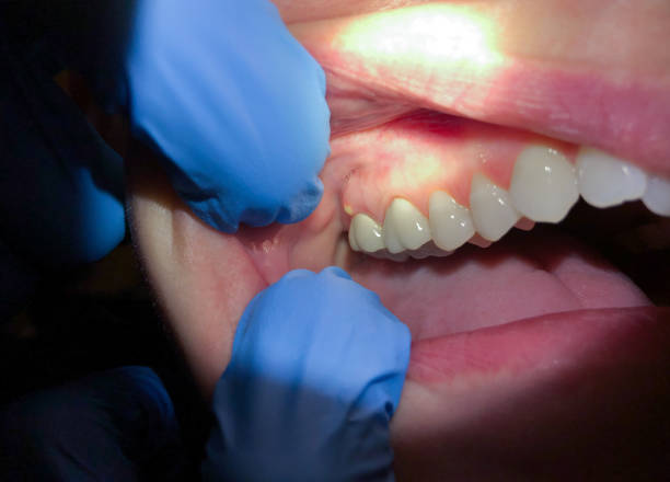 Best Knocked-Out Tooth Emergency  in Huguley, AL